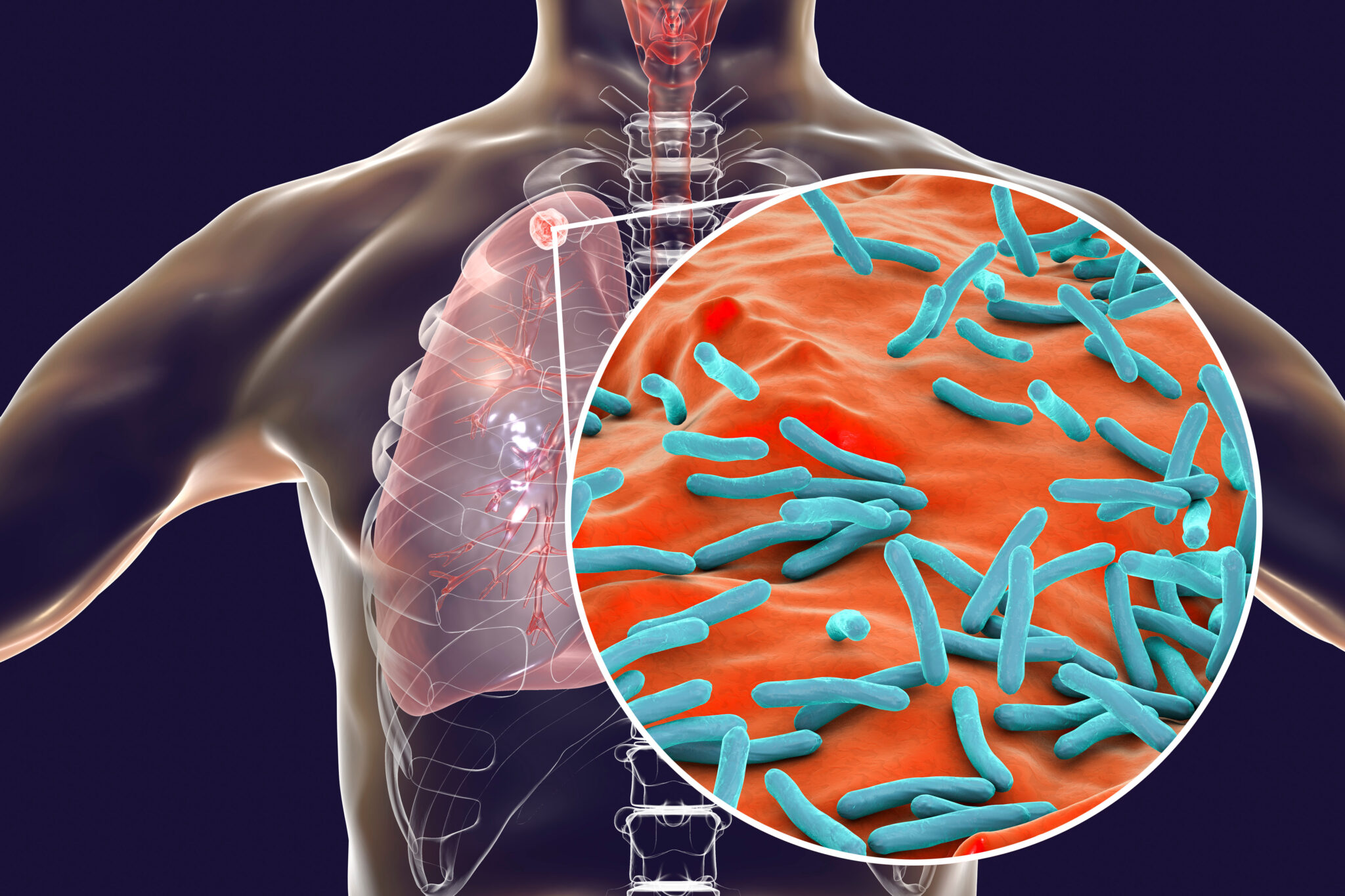 Mycobacterium tuberculosis bacteria